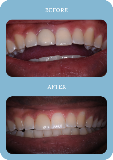 Before and after dental treatment example three