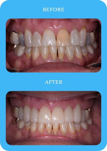Before and after dental treatment example one